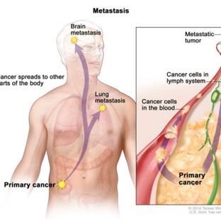 metastasis.png