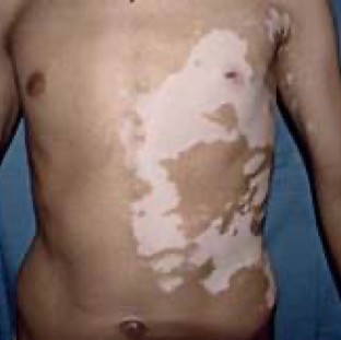 segmental_vitiligo_1.jpeg