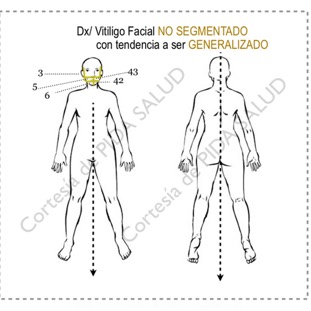vitiligo_generalizado_map.png