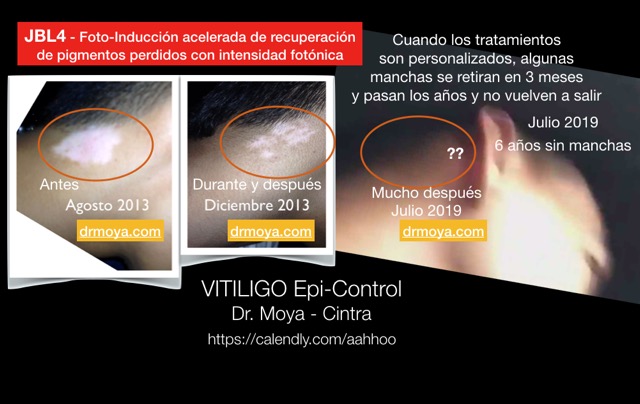 Epi-Control Vitiligo. We can do it.